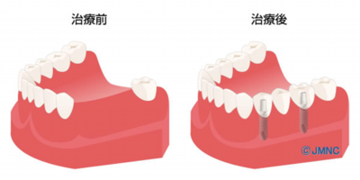 インプラント2