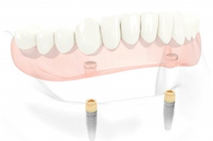 インプラントオーバーデンチャー
